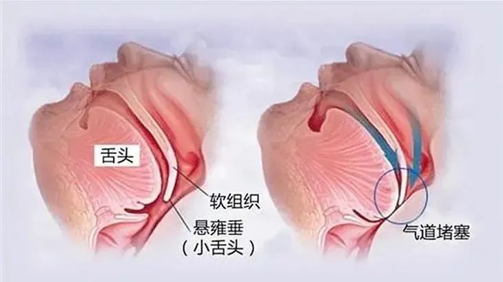 打鼾1.jpg